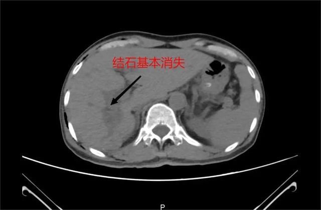 恒生医院|深圳恒生医院利用钬激光碎石术为患者取出数十枚肝内胆管结石