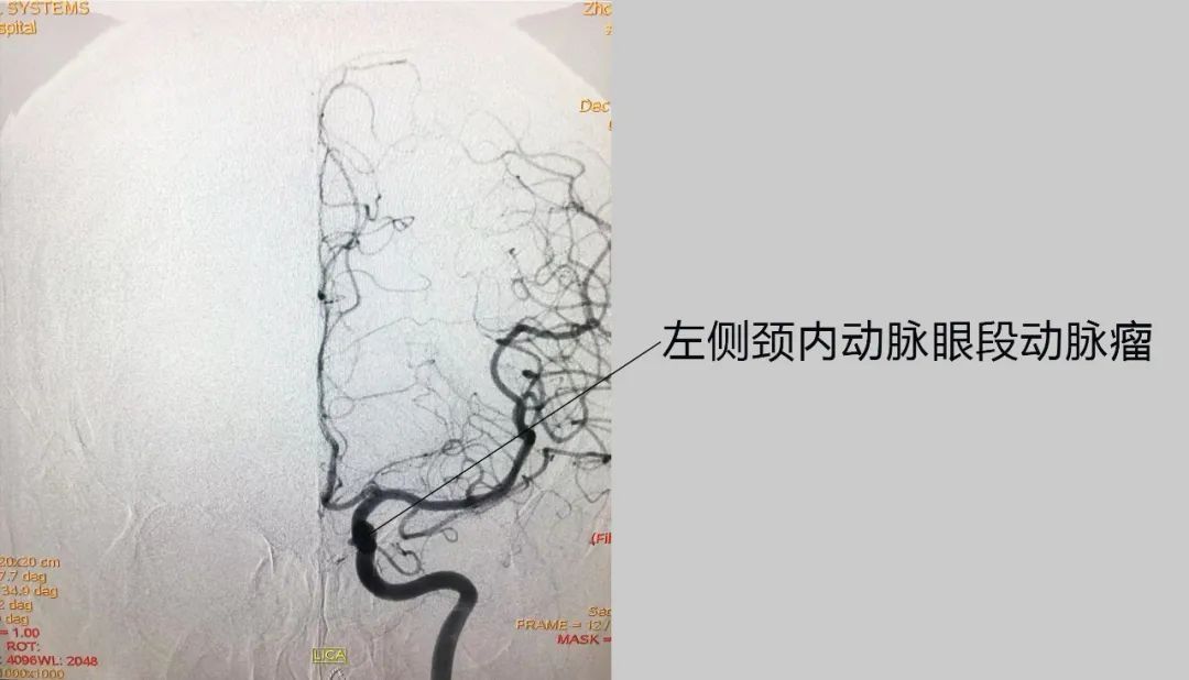 动脉瘤|“拆弹”成功！涿州市医院顺利完成一例动脉瘤栓塞手术