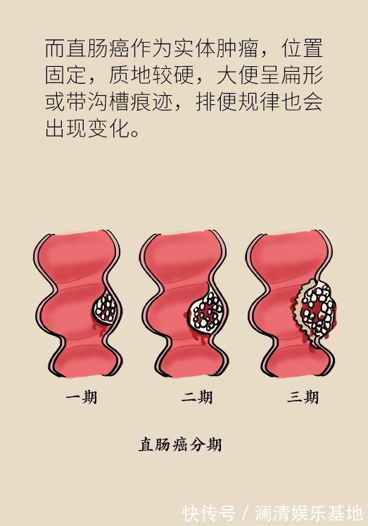 筛查|50岁以后高发的癌症,这5类人提前10年筛查,就能避免太多悲剧