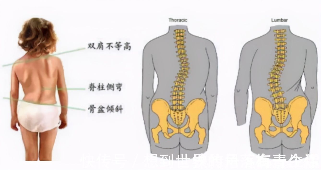 丽丽|为什么现在孩子脊椎容易变形？多半因为宝妈的这3种行为，请住手