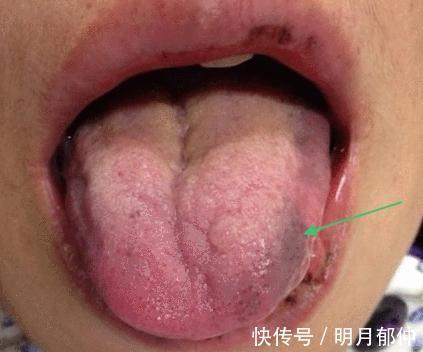 青紫|身体里有肿瘤，舌头上也会有表现！出现3种异象需小心