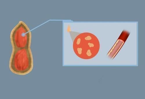 食用|糖尿病人群吃花生,到底是升血糖还是降血糖?