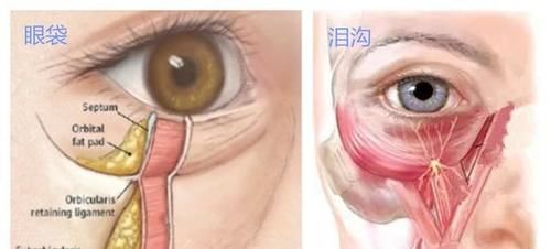 别随便做“眶隔脂肪释放”祛眼袋手术，否则会“后悔”？