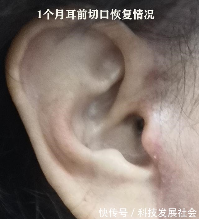 筋膜 关于拉皮手术的16个真相,很多人都不知道真假!