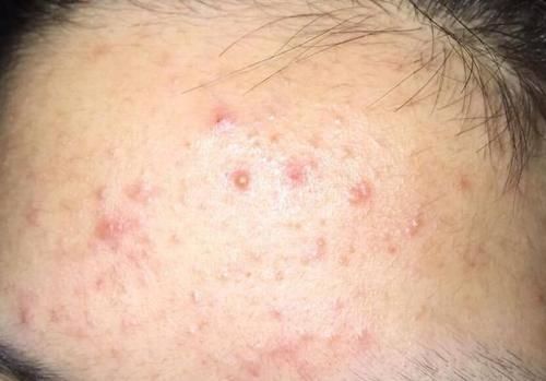 偏高|转氨酶偏高的人，身体会有哪些表现？看完涨知识了