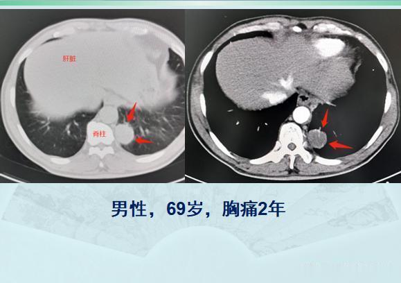 结节|两个肺癌病人都拖了2年才治疗，一个治愈，一个扩散了