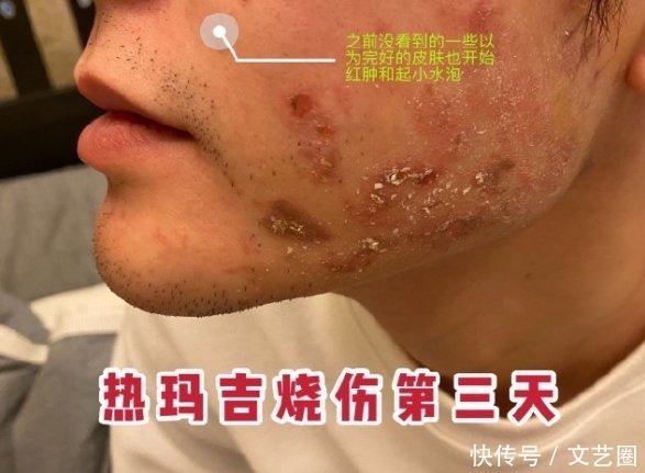 区分浅二度深二度烧伤 区分浅二度深二度烧伤