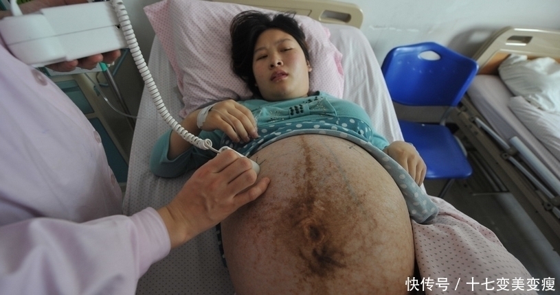 四胞胎|21岁孕妇肚大如箩，医院派出了最强手术阵容，孩子取名健康平安