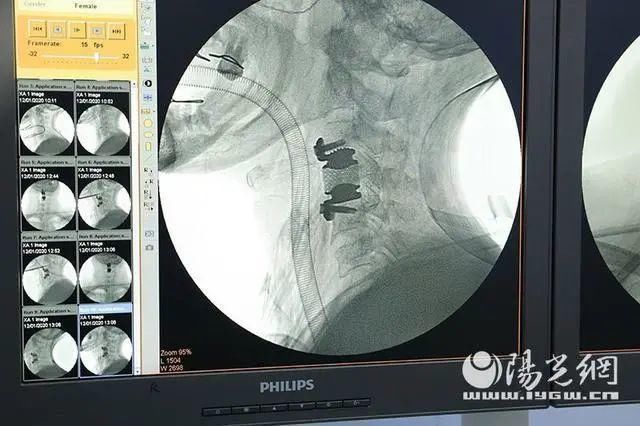 国际医学完成高难度高科技3D打印可动人工颈椎术