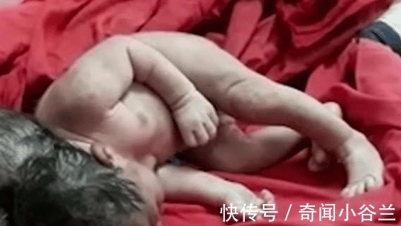 脑肿胀|外国妇女生下三个女孩!没有感觉的时候怀孕了,产科医生:像外星