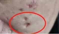 后果|全民护肤日：这些后果严重的皮肤病，却常常被忽视