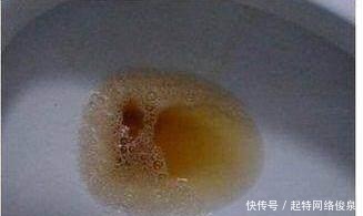 不痒|肝癌不痒不痛, 发现了已是晚期, 身体这5个信号要注意