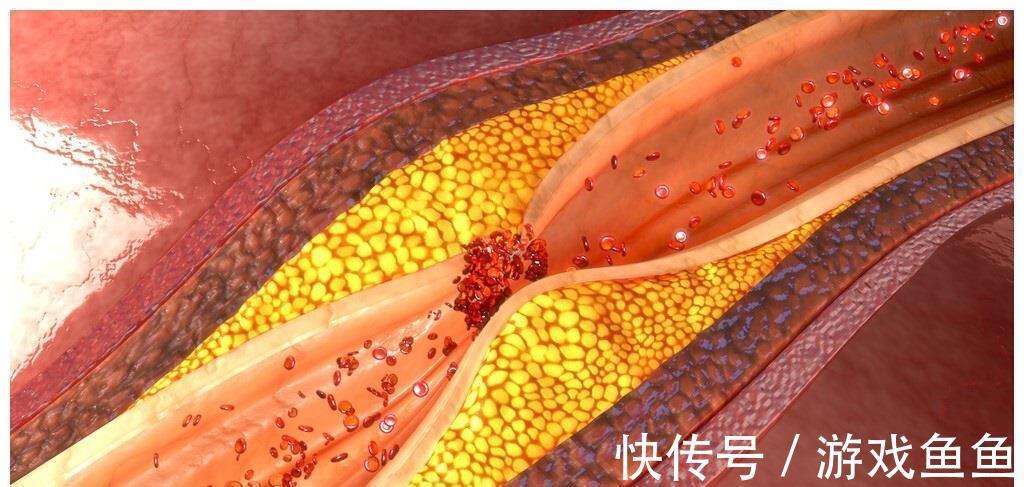 动脉狭窄|如何让动脉狭窄减轻？降低血脂，能使粥样硬化斑块变小吗？