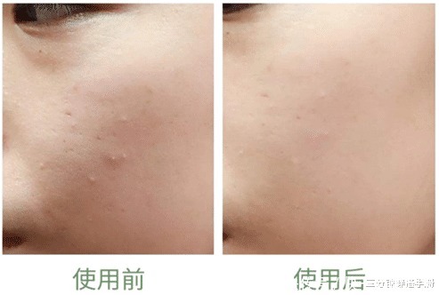 影响|爱挤痘痘的这些女星,现在皮肤都是什么样看这2个例子就知道了