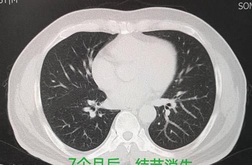 X光透视能查出肺结节吗？