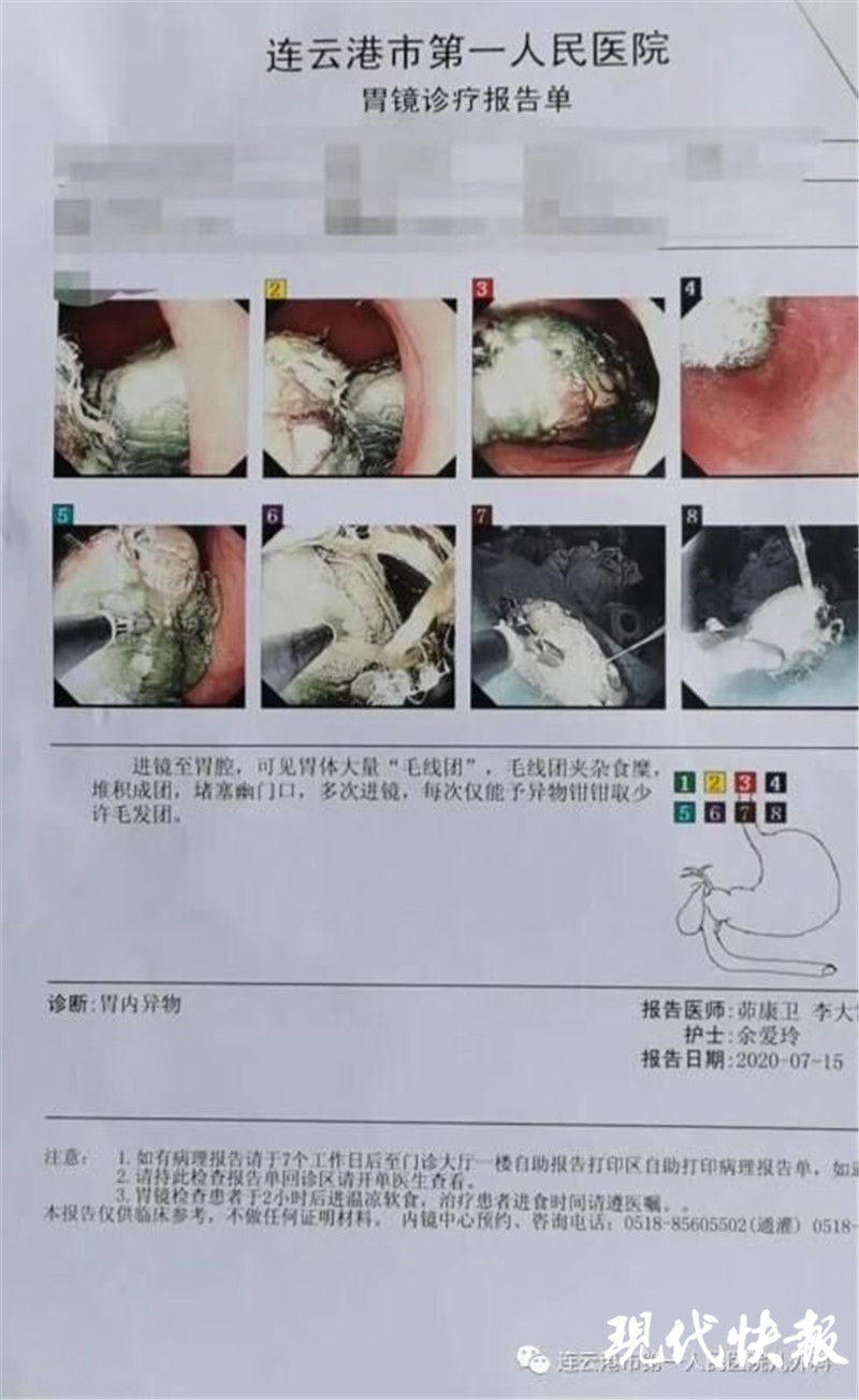 取出|2岁男童连续呕吐3天，医生从他胃内取出1斤多棉絮