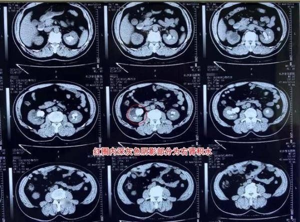 男子|男子每天腰痛到全身冒汗，入院就医才知道……