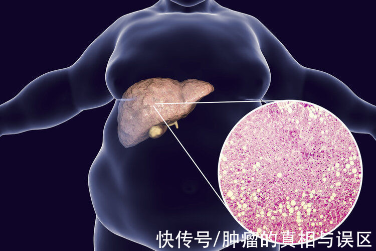 含糖饮料|查出脂肪肝，如何避免恶化？注意“两吃三不吃”，轻度有望逆转