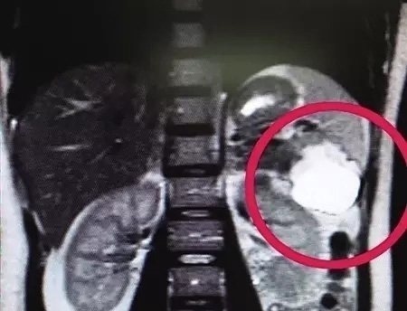 B超检查|做了多次B超检查还是没发现胎儿,医生详细检查后,不由大吃一惊