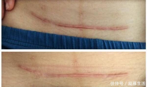 小赵|宝妈剖腹产后,伤口看着都疼,没俩个人扶连起床都难