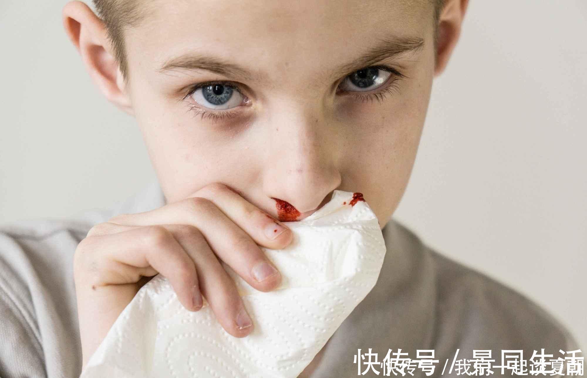 鼻腔|孩子频繁的流鼻血?提醒:或是这些原因引起,教你如何快速止血