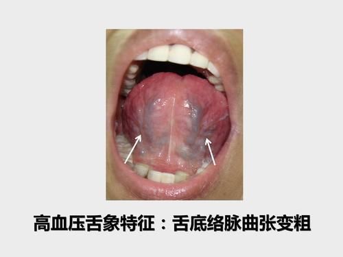 mmhg|50多岁大姐近来老是头晕，一量血压高压180，原来舌象早已预警