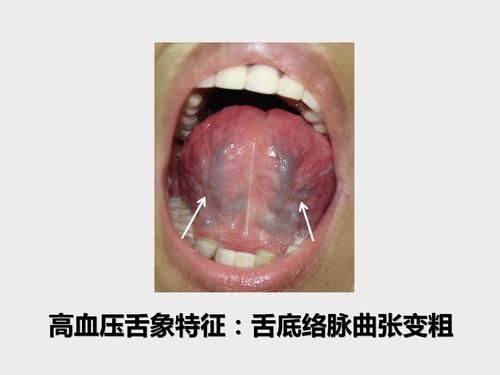 mmhg|50多岁大姐近来老是头晕,一量血压高压180,原来舌象早已预警
