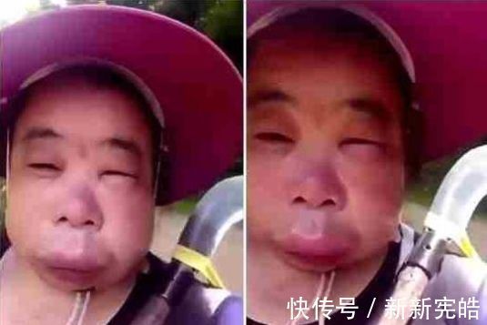 肥皂水|哥哥带着妹妹捅马蜂窝,却被蛰成“猪头”,妈妈迟迟不敢相认