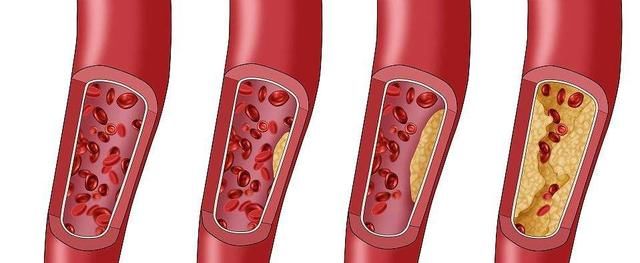  甘油三酯|内科主任：高血脂“祸根”已发现，不是肥肉，若常吃，血管易堵塞