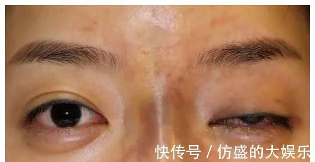 栓塞|爱美妈妈经常做的玻尿酸隆鼻,儿子才做1次竟然就“栓塞”了?