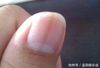 胰岛素抵抗|肝不好,脚部会有3种异常,若你全中,可能是肝“撑不住了”