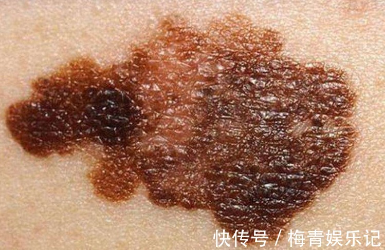 发病率|28岁清华学霸癌症离世，医生告诉：癌症是可怕的，日常需多多注意