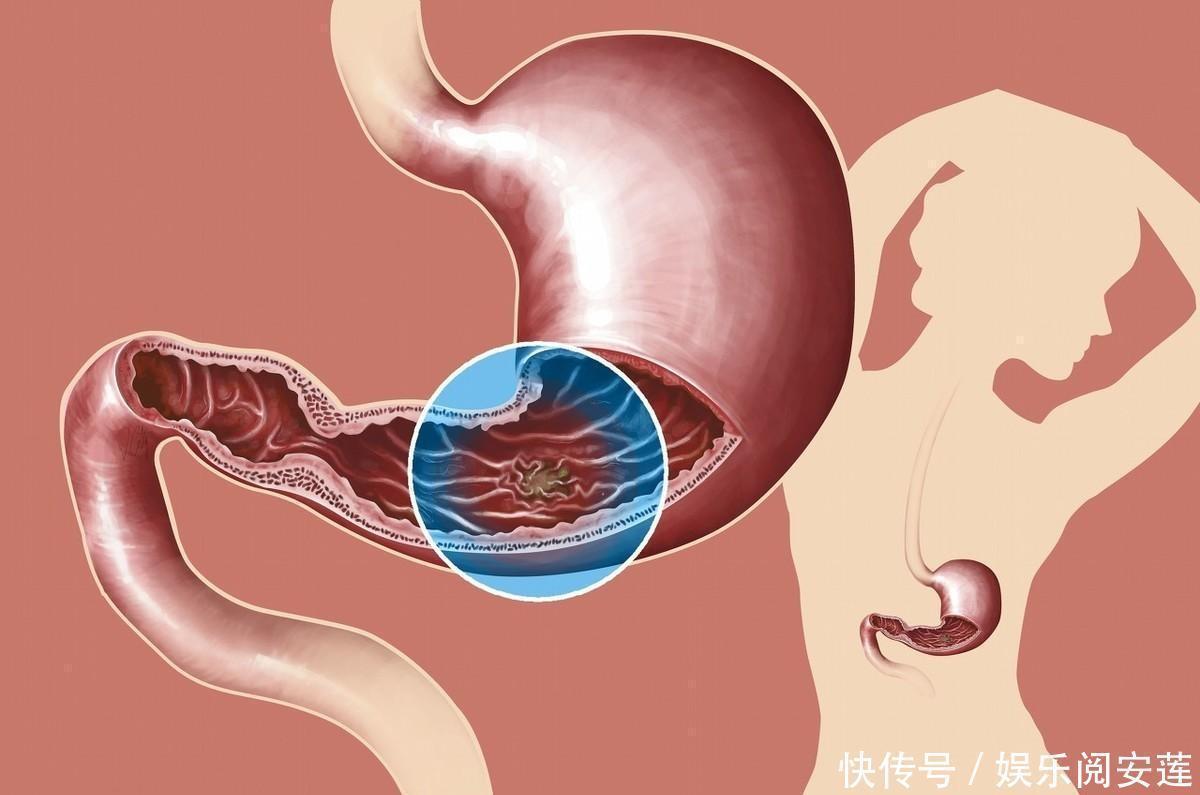食物|张文宏：胃不好尽量选择少喝粥，这两种食物是不错的选择，可多吃