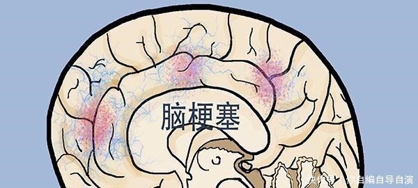 头晕|脑梗塞发生前，身体或频繁亮起4个“红灯”！自测下，希望你没有！
