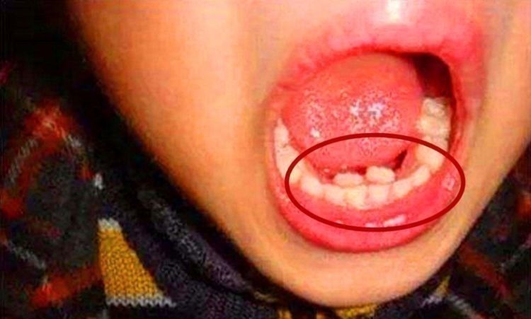 刷牙|7岁男孩长了“双排牙”,需要一颗一颗拔掉,奶奶:都怪我