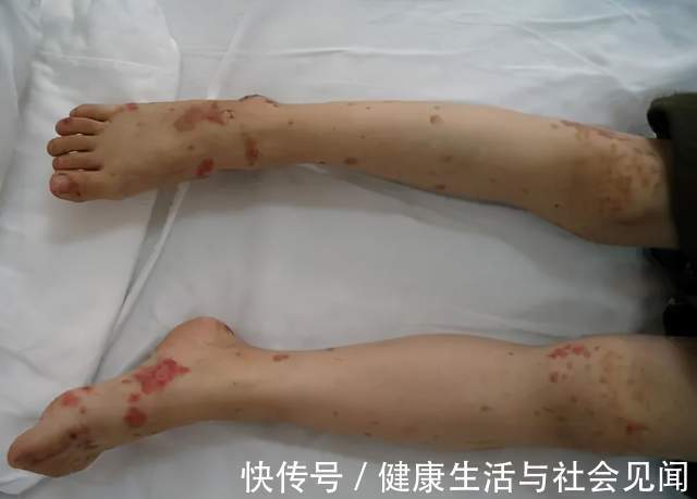 过敏性紫癜|过敏性紫癜怎样才算好转？过敏性紫癜要怎么治才能不复发？