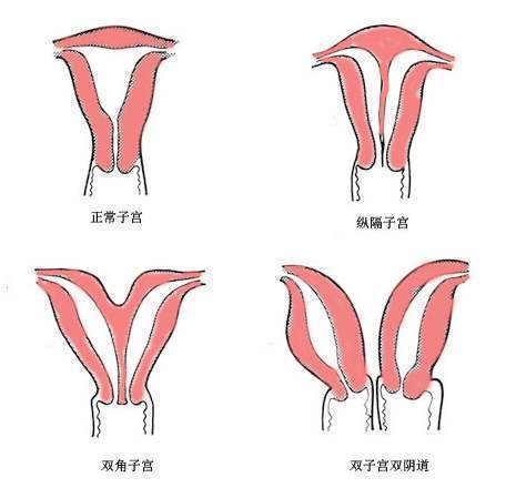 双角|双角子宫女性是否合适做试管婴儿？