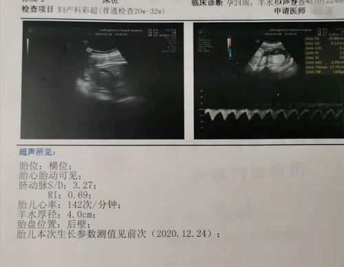 怀孕25周男孩胎动情况