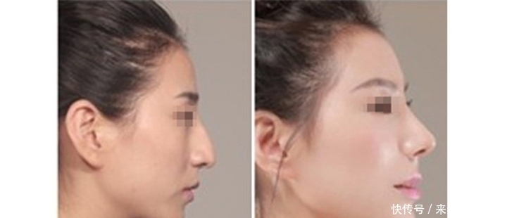 眼是美之窗，鼻是颜之魂；范芳医生谈国人常见鼻型及美学特点一