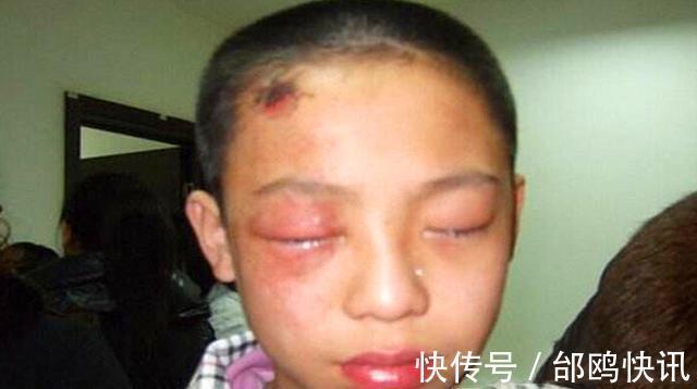 吴女士|3岁男孩把石灰撒进眼睛,妈妈却不敢用水洗,事后医生骂无知