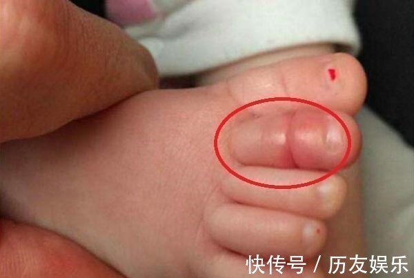 宝宝|11月龄宝宝脚趾进“虫”，家长紧急送医，医生直言幸好来得早
