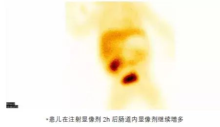 胆道|患儿持续黄疸，核医学无创检查助力探究病因