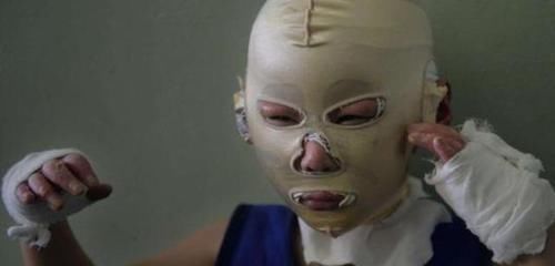 孩子|男孩被开水烫伤,宝妈的做法被全家人反对,送医后反被医生夸赞