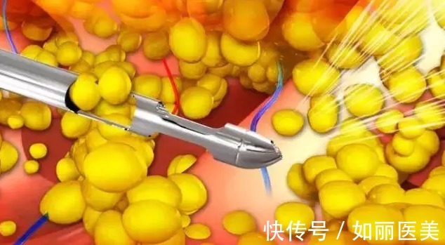 抽脂 吸脂手术疼痛度如何?术后怎样才能快速恢复呢?