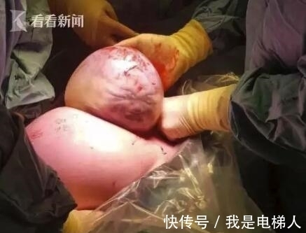 哪吒|医生从妈妈肚子里取出一个肉球!网友:这是哪吒啊