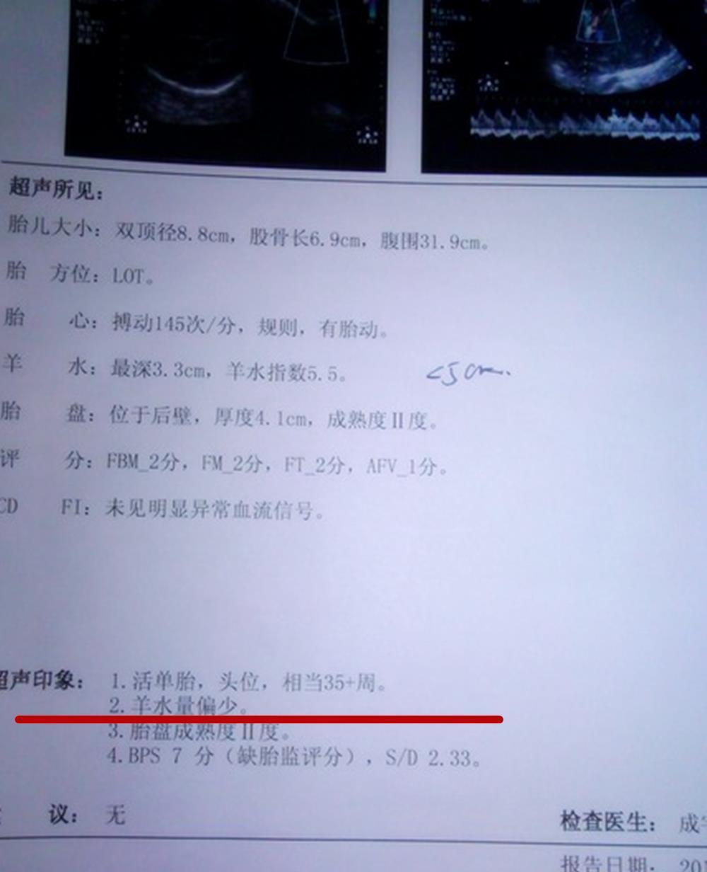 孕妈|在孕期,孕妈排尿出现两种情况,说明羊水不足了,快采取有效措施