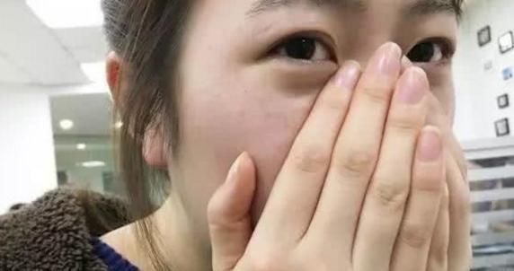 脂溢性皮炎|鼻翼两侧挤出白色分泌物是啥?别再用手挤了,当心越来越多