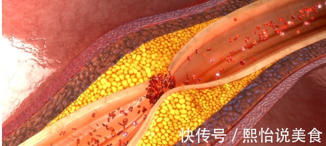 低热量|高血脂是吃出来的坚持“两低一高”饮食,2个月轻松吃掉高血脂