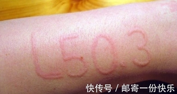 口腔过敏综合征|世界上十大最奇葩的过敏,让我们盘点一下奇特的过敏原