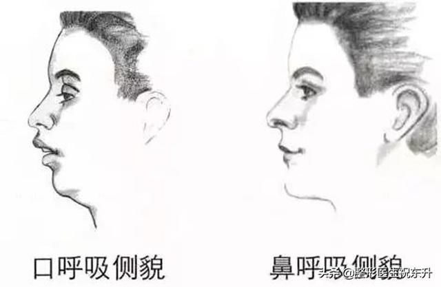 怎么提升侧颜的高级感？医生来支招：找回消失的下颌线